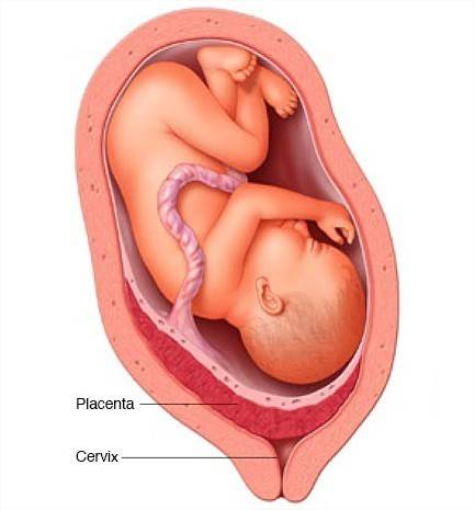 What would occur if a fetus's villi tissue ruptured?    the maternal tissue of the placenta wou