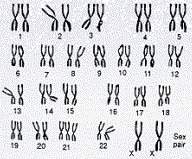 Which chromosome is abnormal or carries a genetic mutation? a. 13th pair b. 21st pair c. 23rd pair