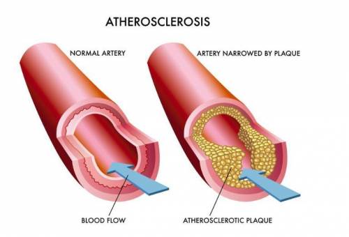 What is the impact of arteriosclerosis