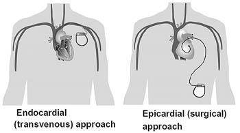 List the two approaches used to insert electrodes for devices that electrically shock the heart into