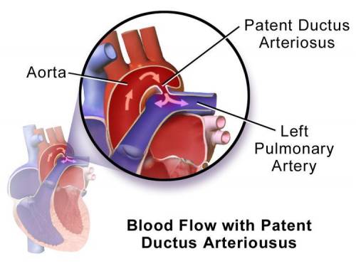 A patent ductus arteriosus permits .  -the deoxygenated blood pumped out by the left ventricle to qu
