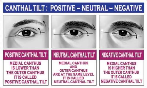 Negative canthal tilt = death sentence if you have this you are a subhuman