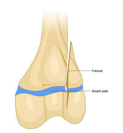 "each long bone has at least two growth plates, also called epiphyseal plates. the growth plat