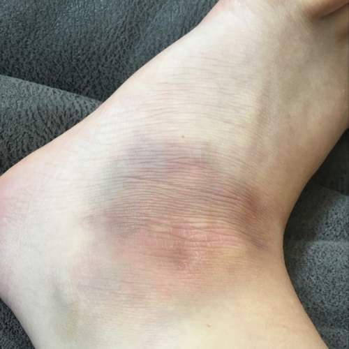 Health.  what does the bruised, discolored, look on the skin at the ankle bone mean?  (