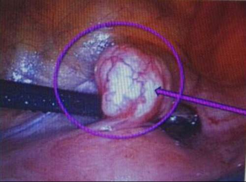 What is the diagnose? a. ovarian tumor b. subserous cyst c. myoma