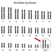 Klinefelter syndrome in humans leads to underdeveloped testes and sterility. this is caused by which