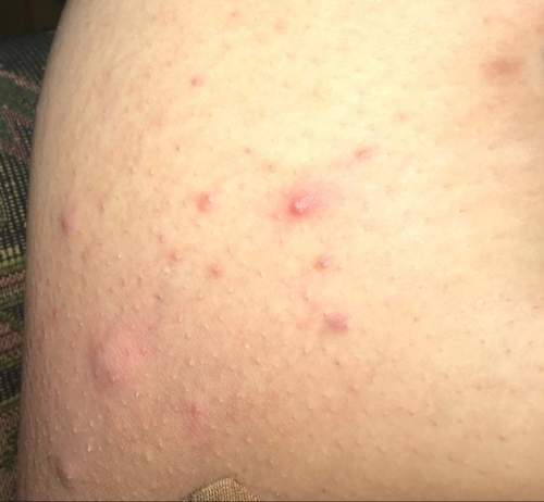 How do you get rid of and heal these bumps on the inner thighs? is this normal? is it common? wha