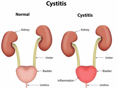 Cystitis is an inflammation of the bladder usually caused by an ascending organism introduced throug
