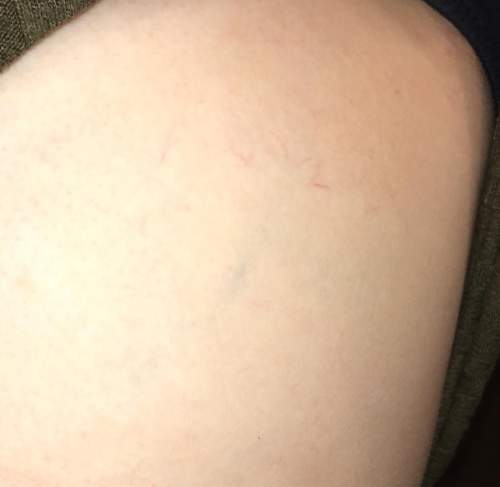Ihave these veins on the side of my ribs, what are they?