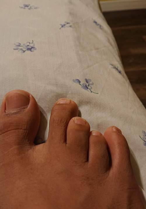 What type of toe/disorder is this? have had this since birth