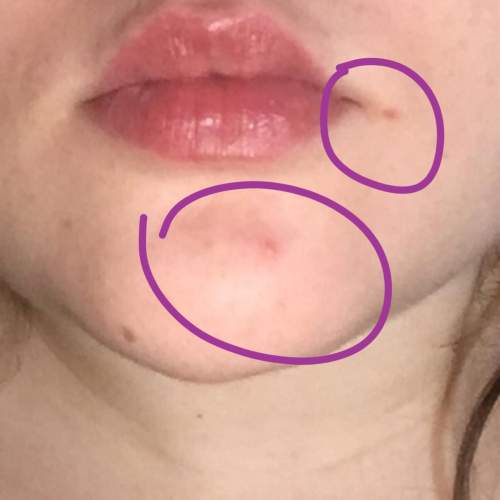 How do i get rid of these blemishes? i usually have perfect skin, but occasionally i’ll have these.