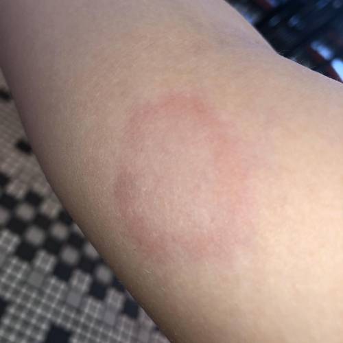 Is this ringworm ???????