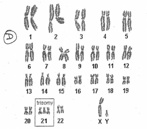 Chromosome 21 figure D is the result of a process known as________