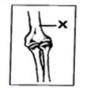 Asap Help

Observe the picture given below and identify the X?a.Femurb.Ulnac.Tibiad.Humerus