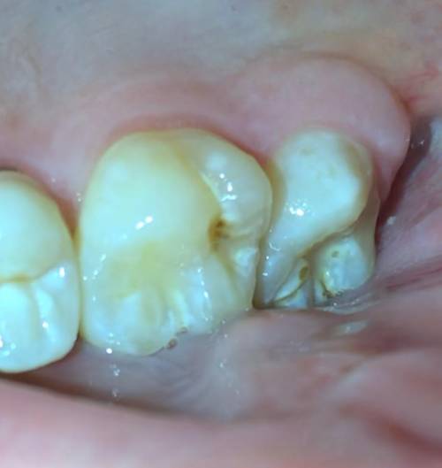 WHAT IS THIS ON MY TOOTH??? STAINING?