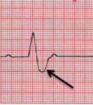 Which statement describes the condition of the heart at the point indicated in the electrocardiogra
