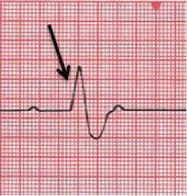 Which statement describes the condition of the heart at the point indicated in the electrocardiogra