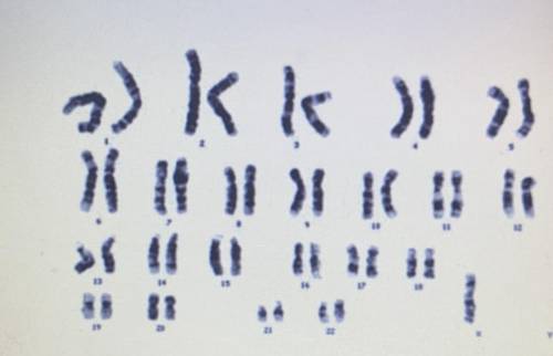 What is wrong with this person's karyotype