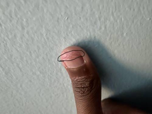 Can someone tell me what part of the fingernail this is , this really hurts