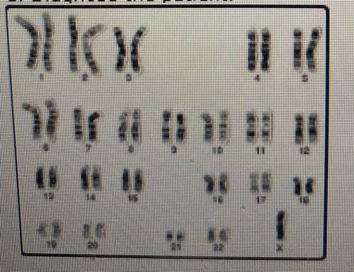 1. Patient A:

Using the karyotype below and the chart from the last screen:
A. Determine the sex