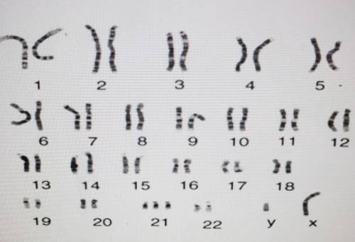 The person whose karyotype is shown below which has which disorder?​
