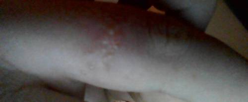 What bug bite is this? Plz help sorry pic is a little blurry!
