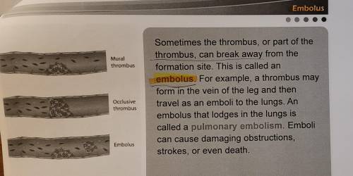 An embolus can cause which of the following?